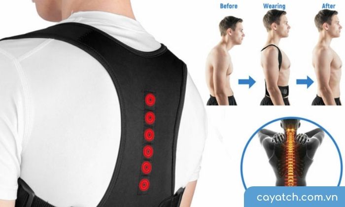 Bệnh gù lưng được cải thiện hiệu quả sau khi đeo đai chống gù lưng