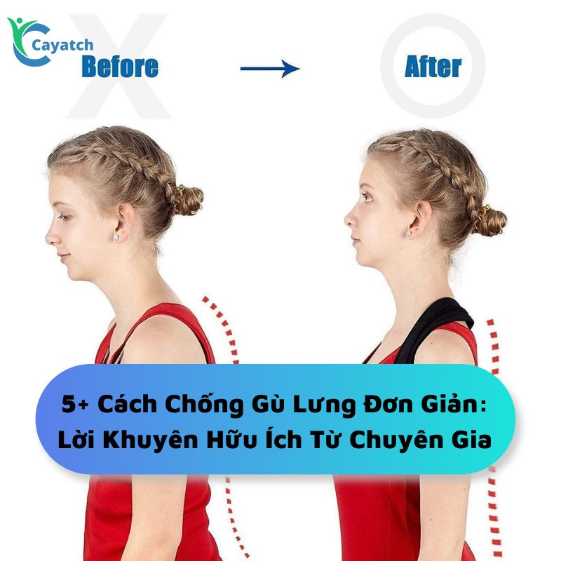 Cách chống gù lưng