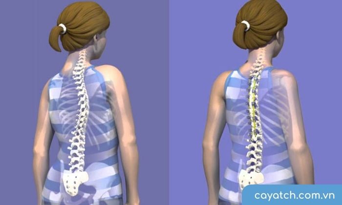 Bệnh gù lưng gây ảnh hưởng lớn đến sức khỏe con người