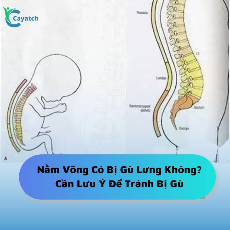 nằm võng có bị gù lưng không